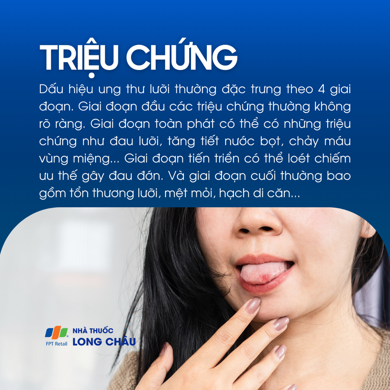 Ung thư lưỡi 2
