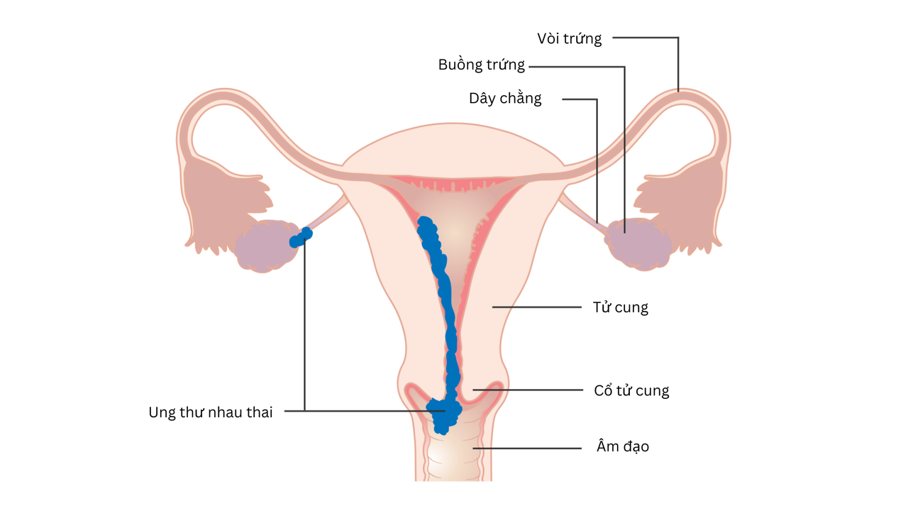 Ung thư nhau thai: Nguyên nhân, triệu chứng, chẩn đoán và điều trị 1