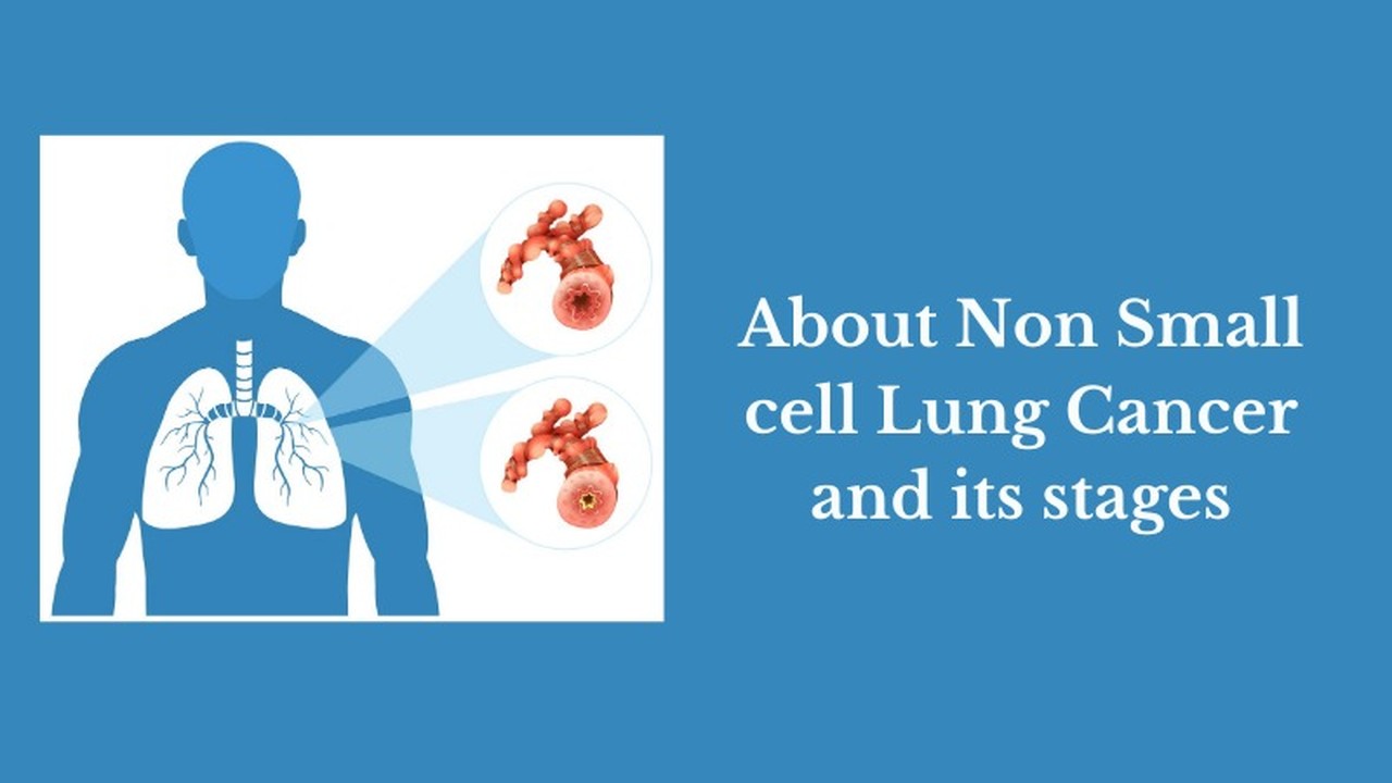 Ung thư phổi không tế bào nhỏ giai đoạn 1 là gì? Cơ hội chữa khỏi và cách phòng ngừa bệnh 1