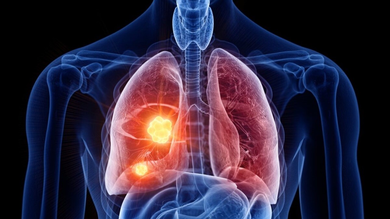 Ung thư phổi không tế bào nhỏ giai đoạn III cần chú ý những gì? 1