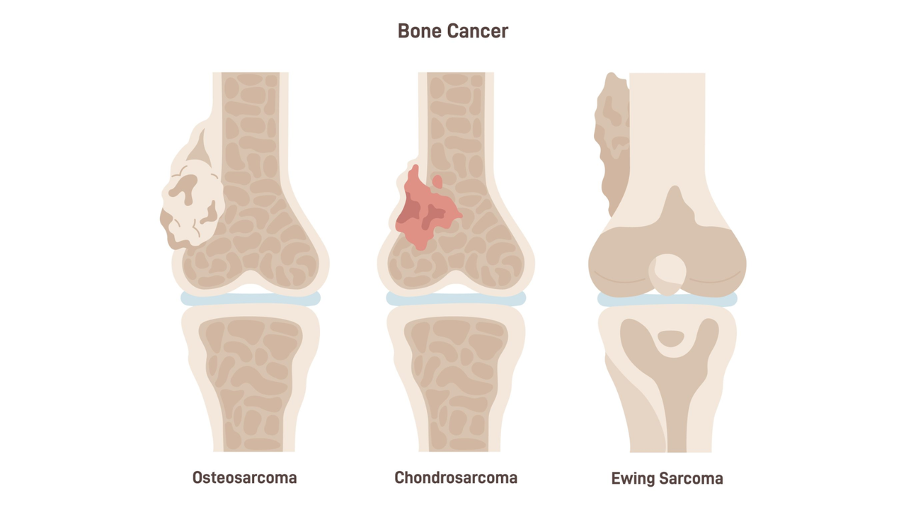 Ung thư sụn là gì? Triệu chứng, nguyên nhân, chẩn đoán và điều trị 1