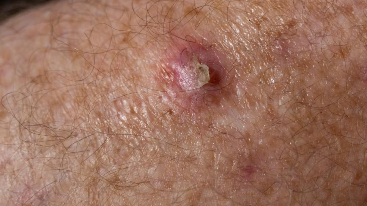 Ung thư tế bào vảy là gì? Triệu chứng, nguyên nhân, chẩn đoán và điều trị bệnh 1