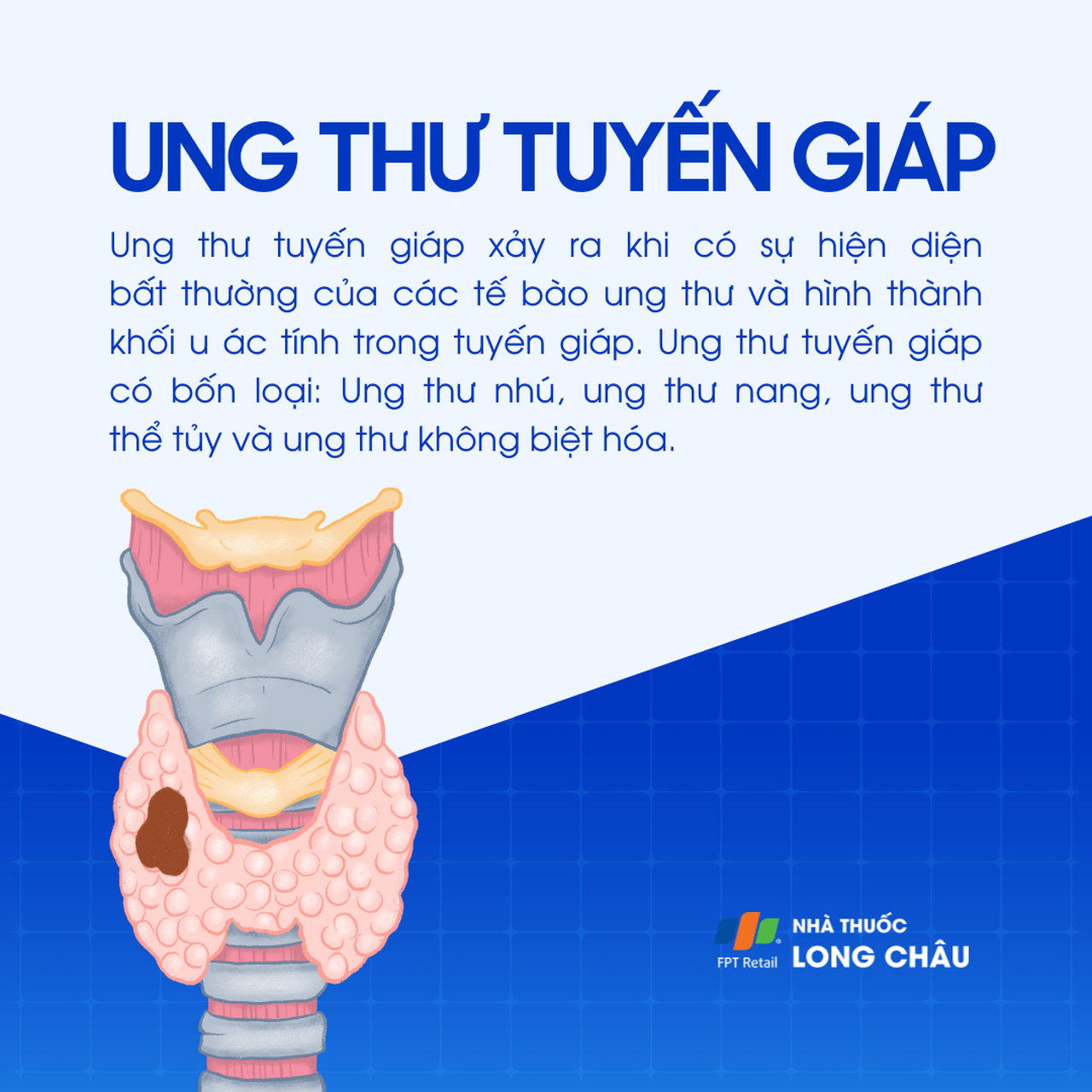 Ung thư tuyến giáp 1