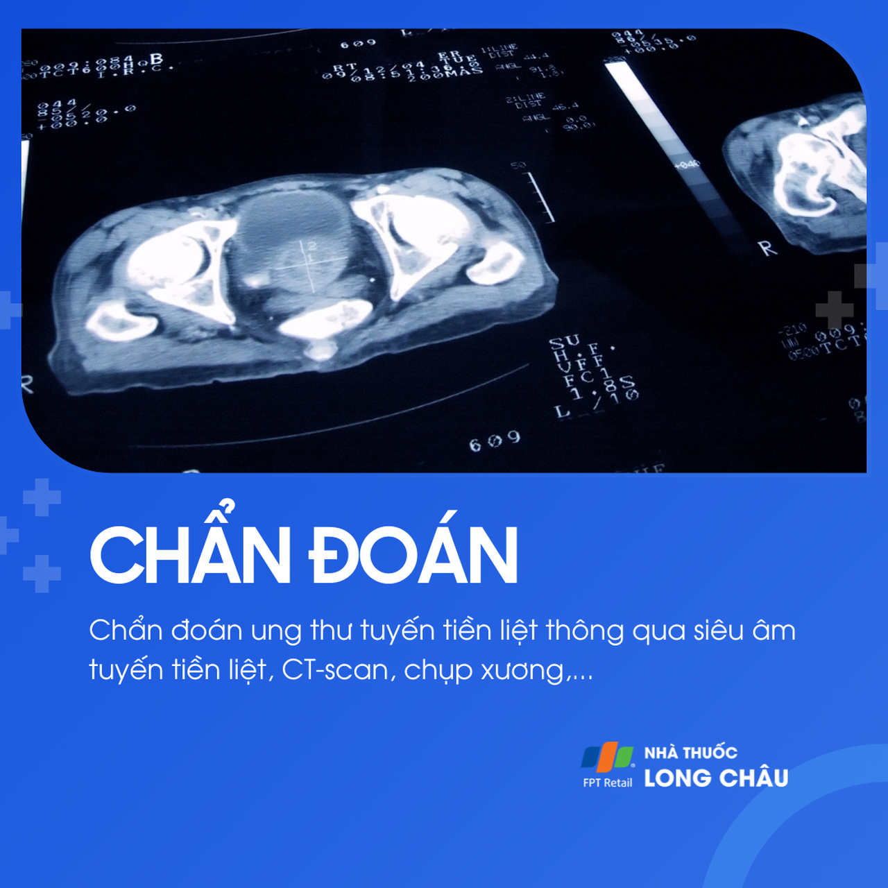 Ung thư tuyến tiền liệt 5