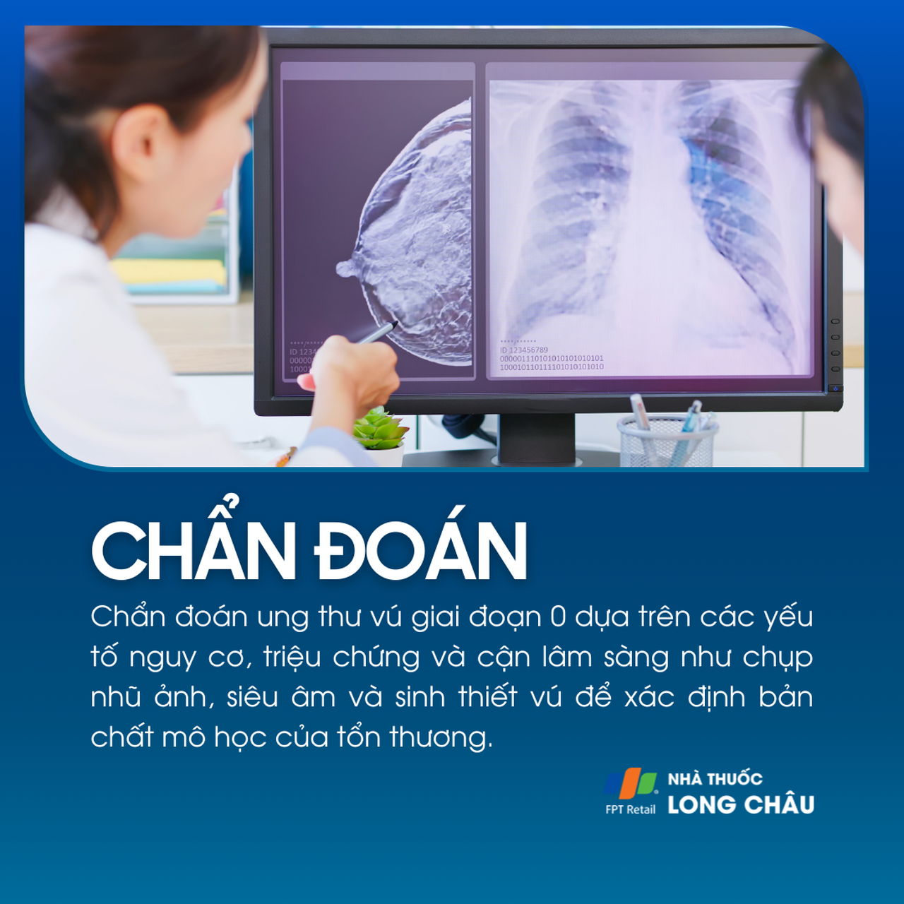 Ung thư vú giai đoạn 0 5