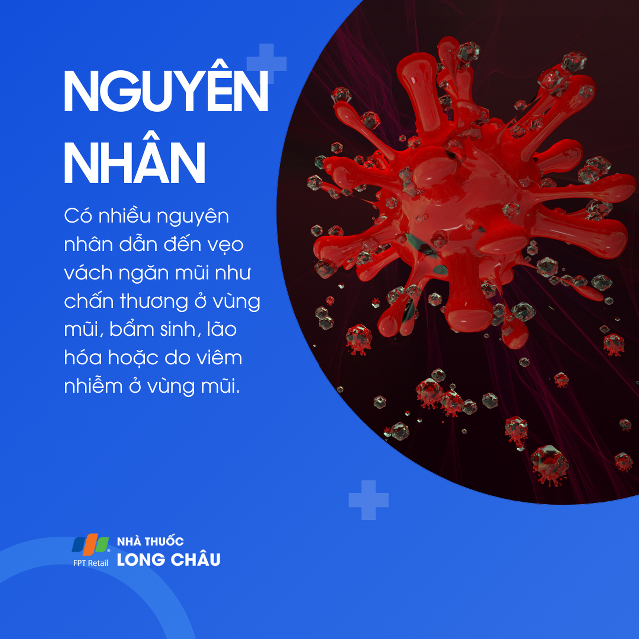 Vẹo vách ngăn mũi 3