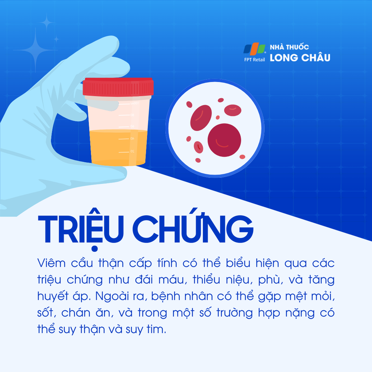 Viêm cầu thận cấp 2