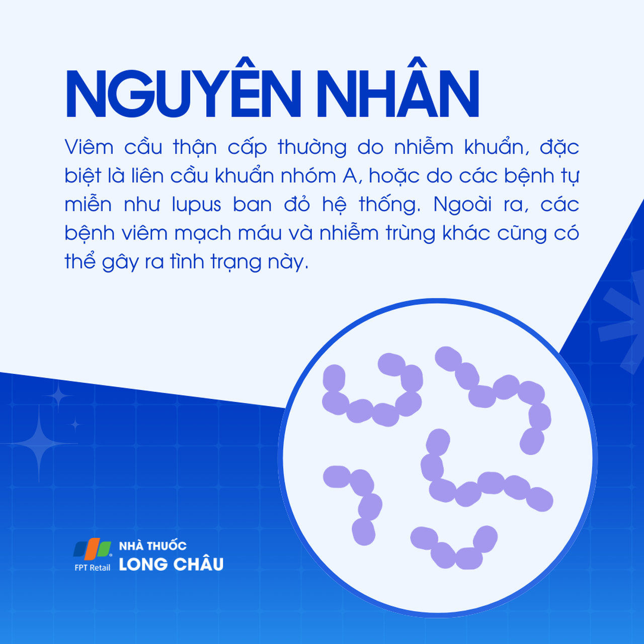 Viêm cầu thận cấp 3