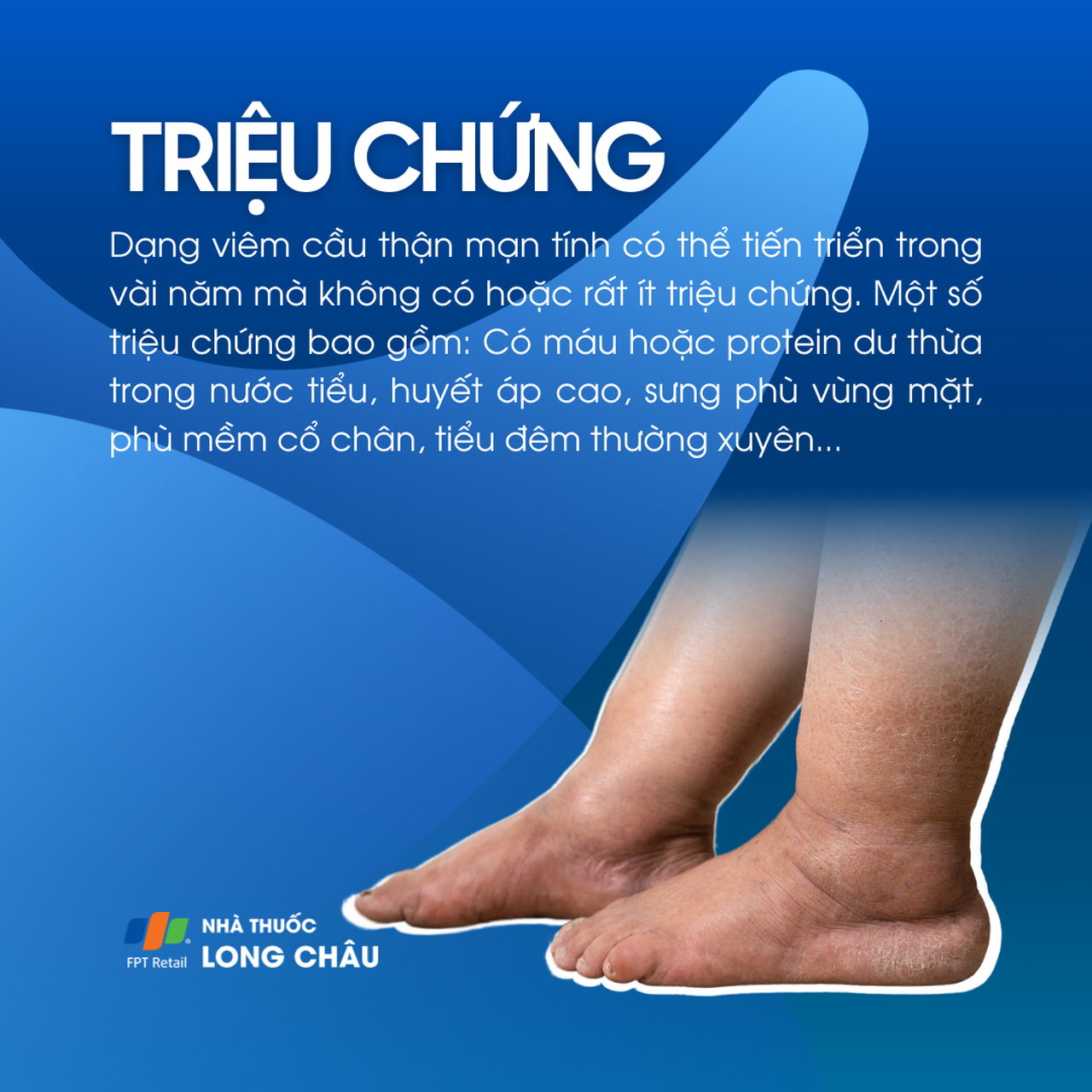 Viêm cầu thận mạn 2