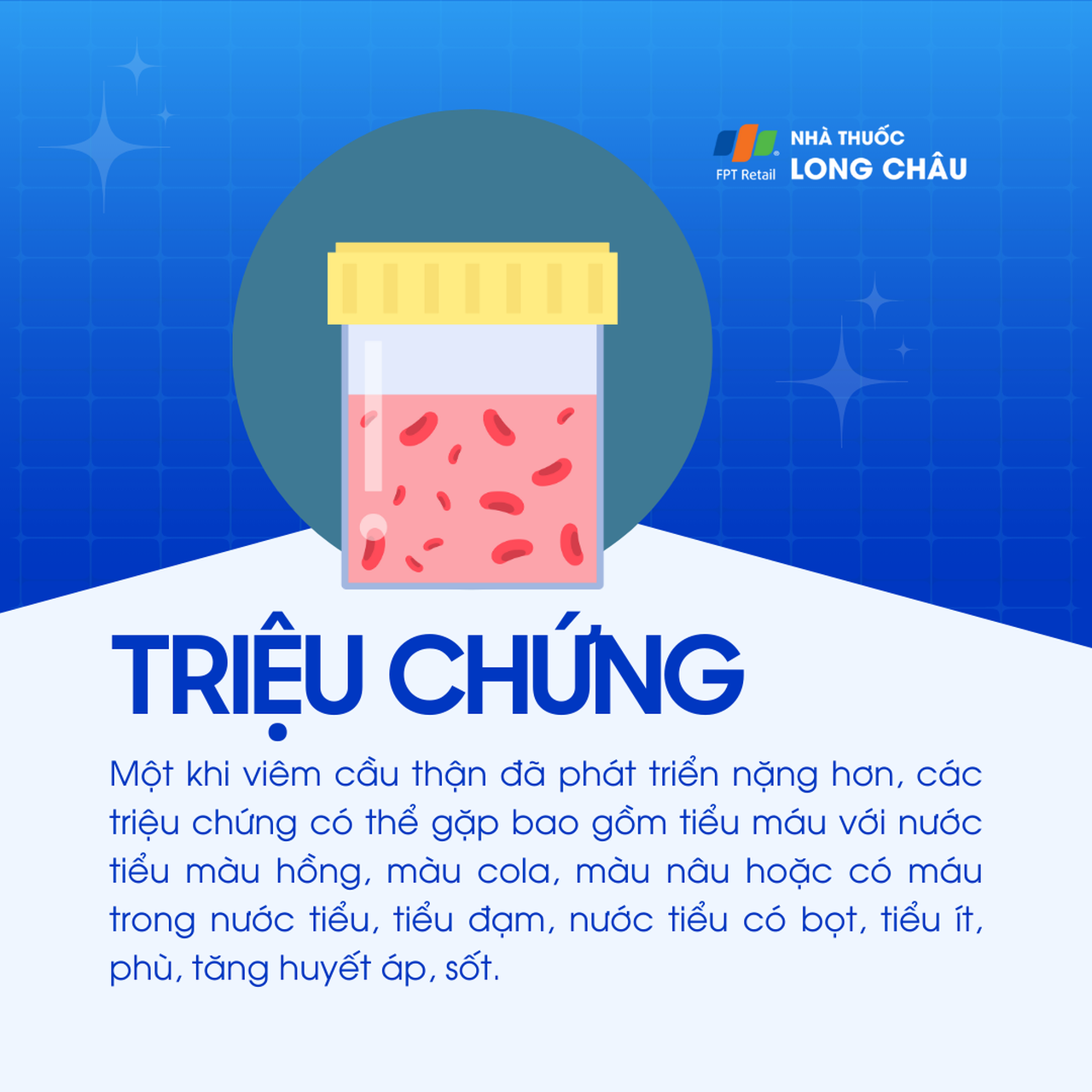 Viêm cầu thận sau nhiễm trùng 2