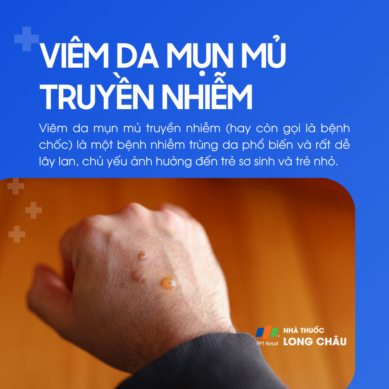 Viêm da mụn mủ truyền nhiễm 1