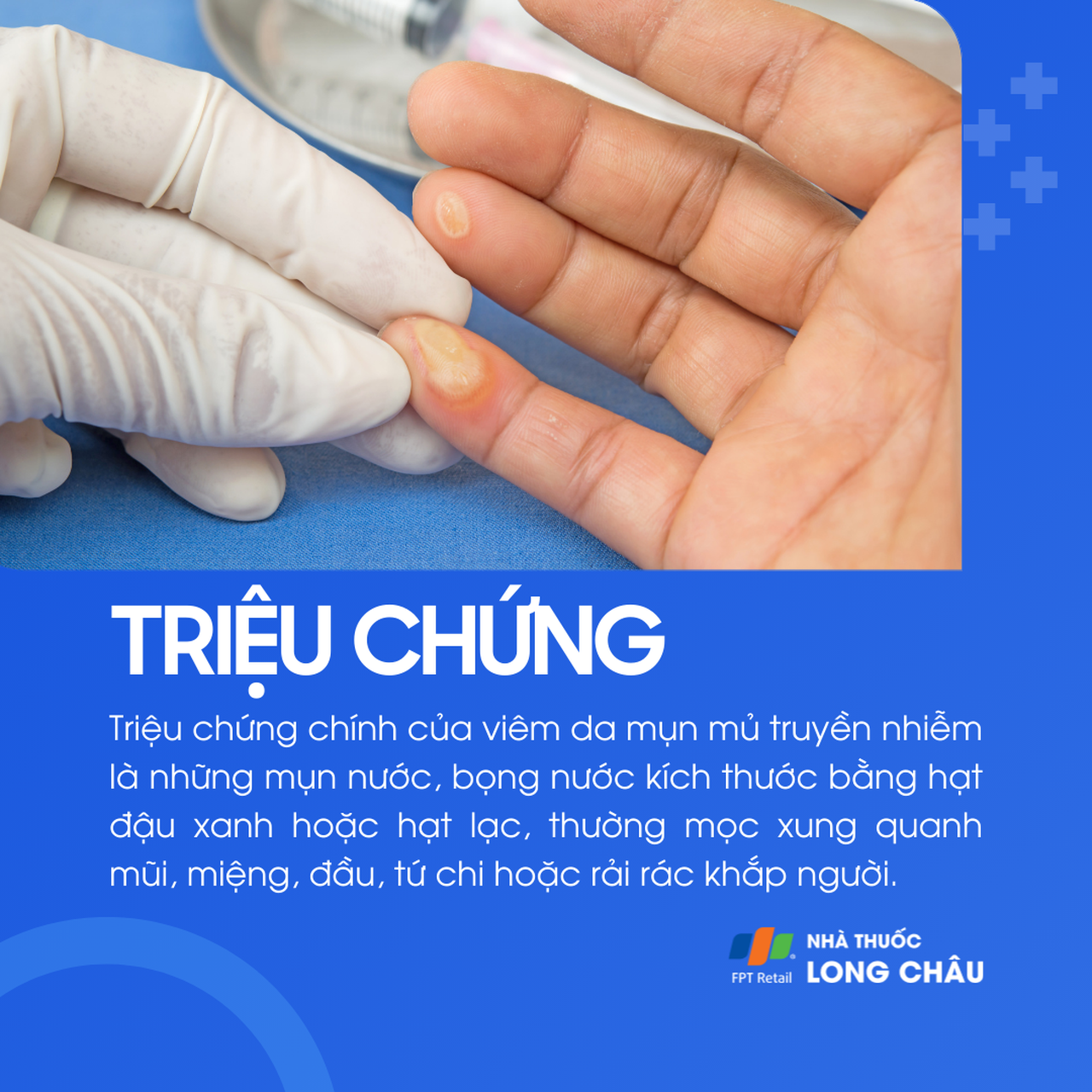 Viêm da mụn mủ truyền nhiễm 2
