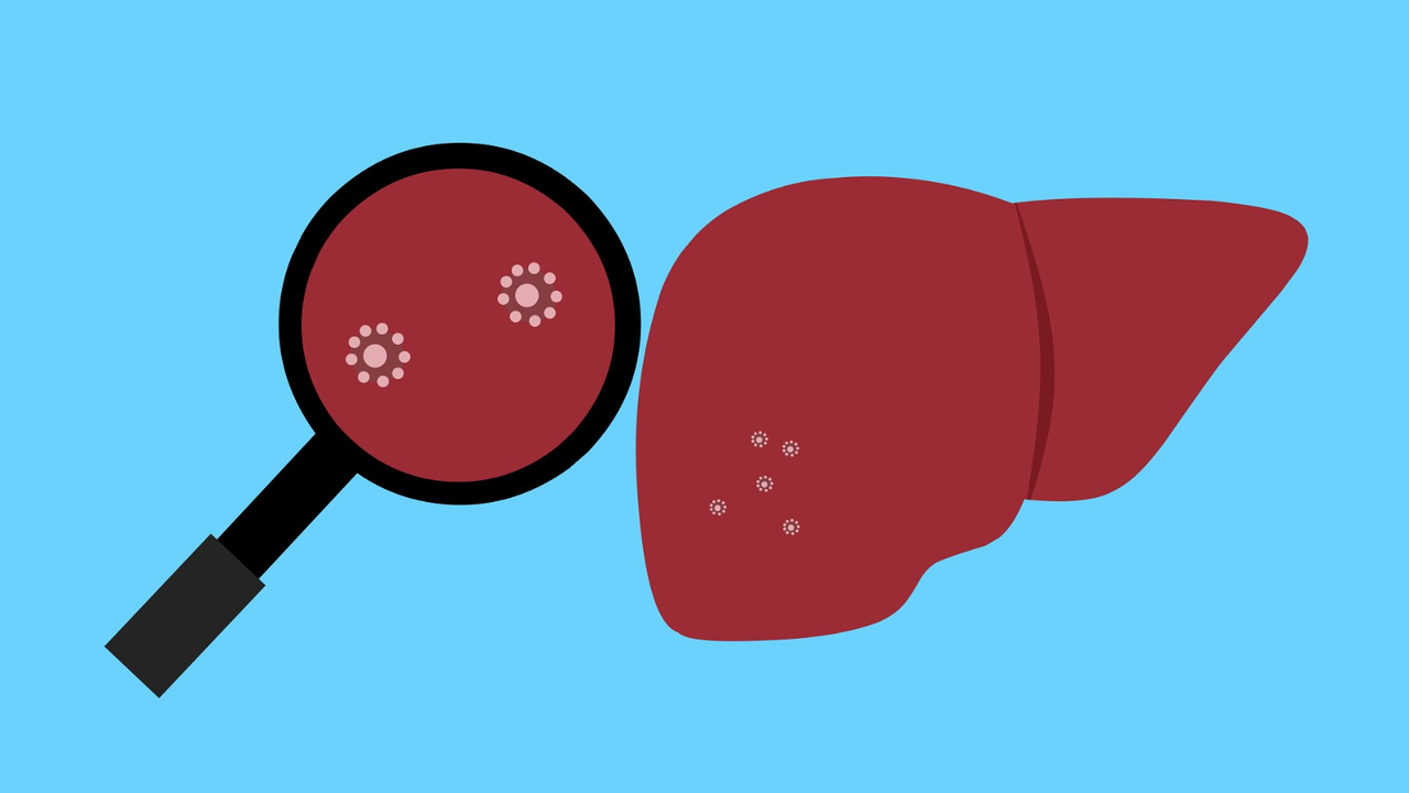 Viêm gan bí ẩn​ là gì? Triệu chứng, nguyên nhân, chẩn đoán, điều trị và phòng ngừa 2