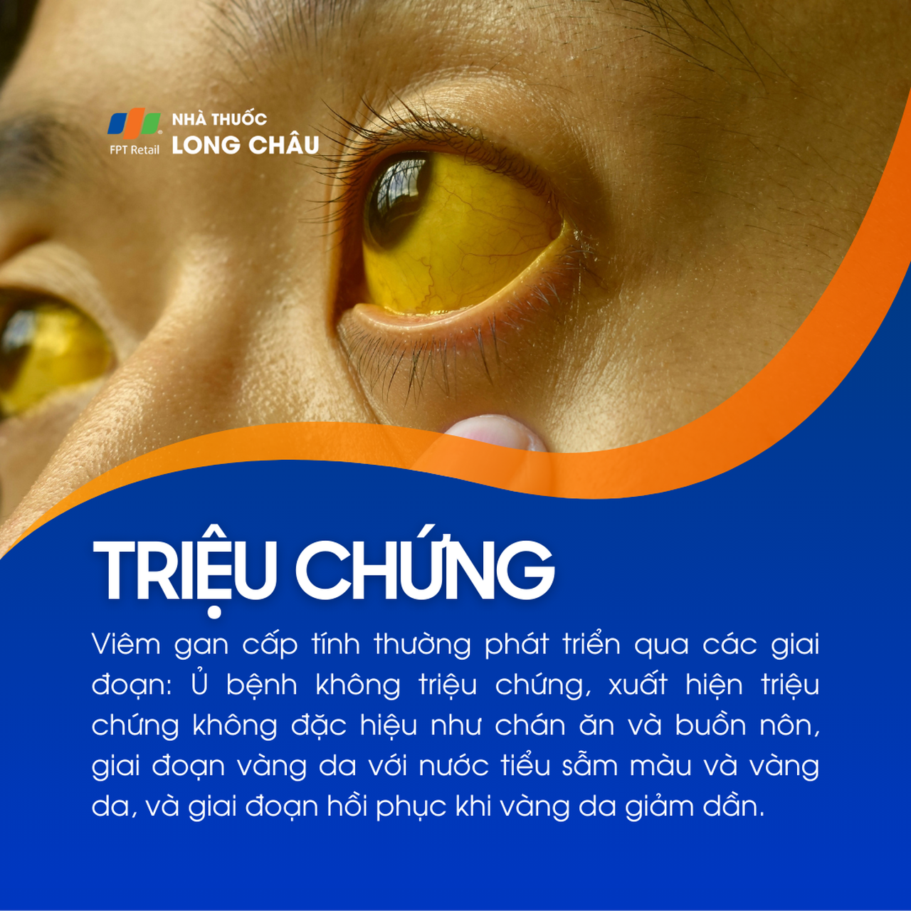 Viêm gan cấp tính 2