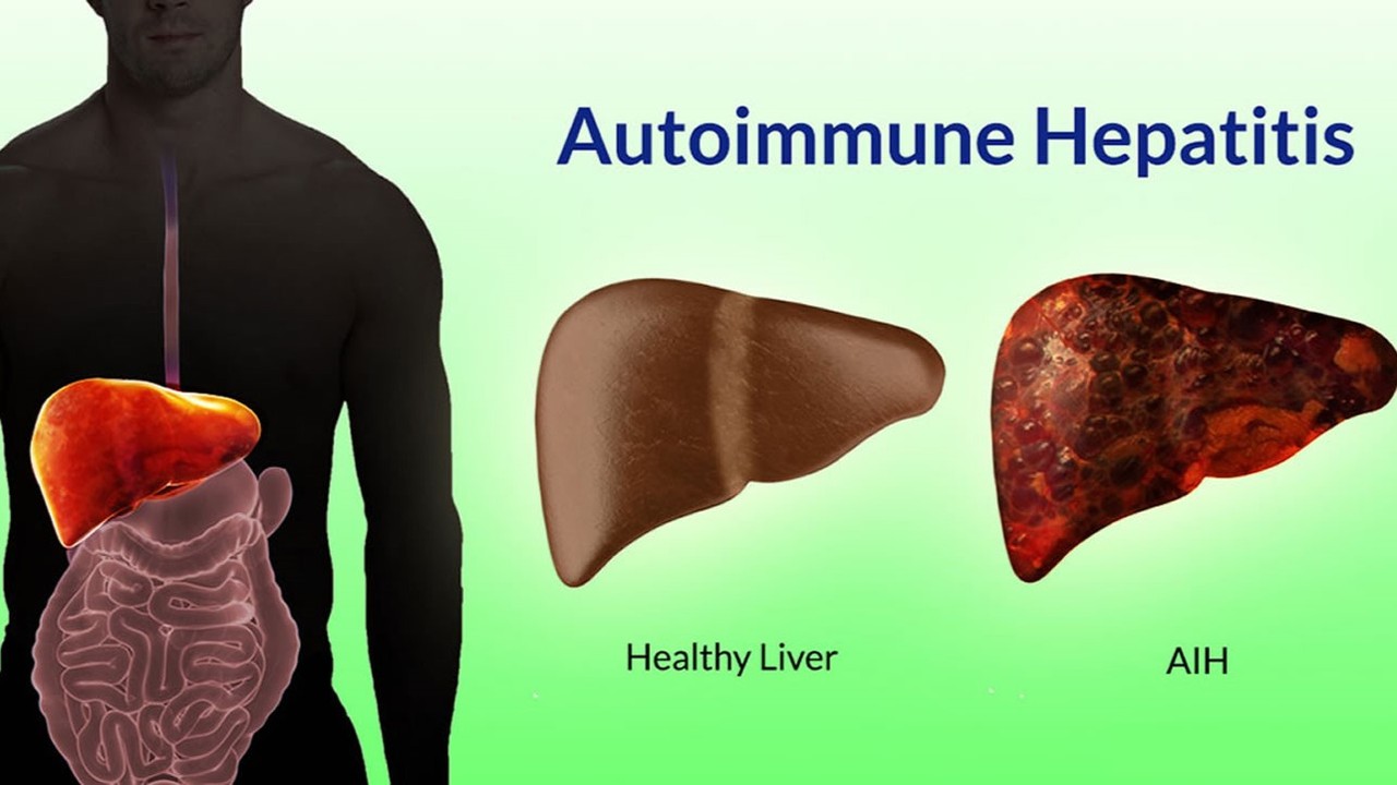 Gan người bình thường và gan bị mắc bệnh viêm gan tự miễn