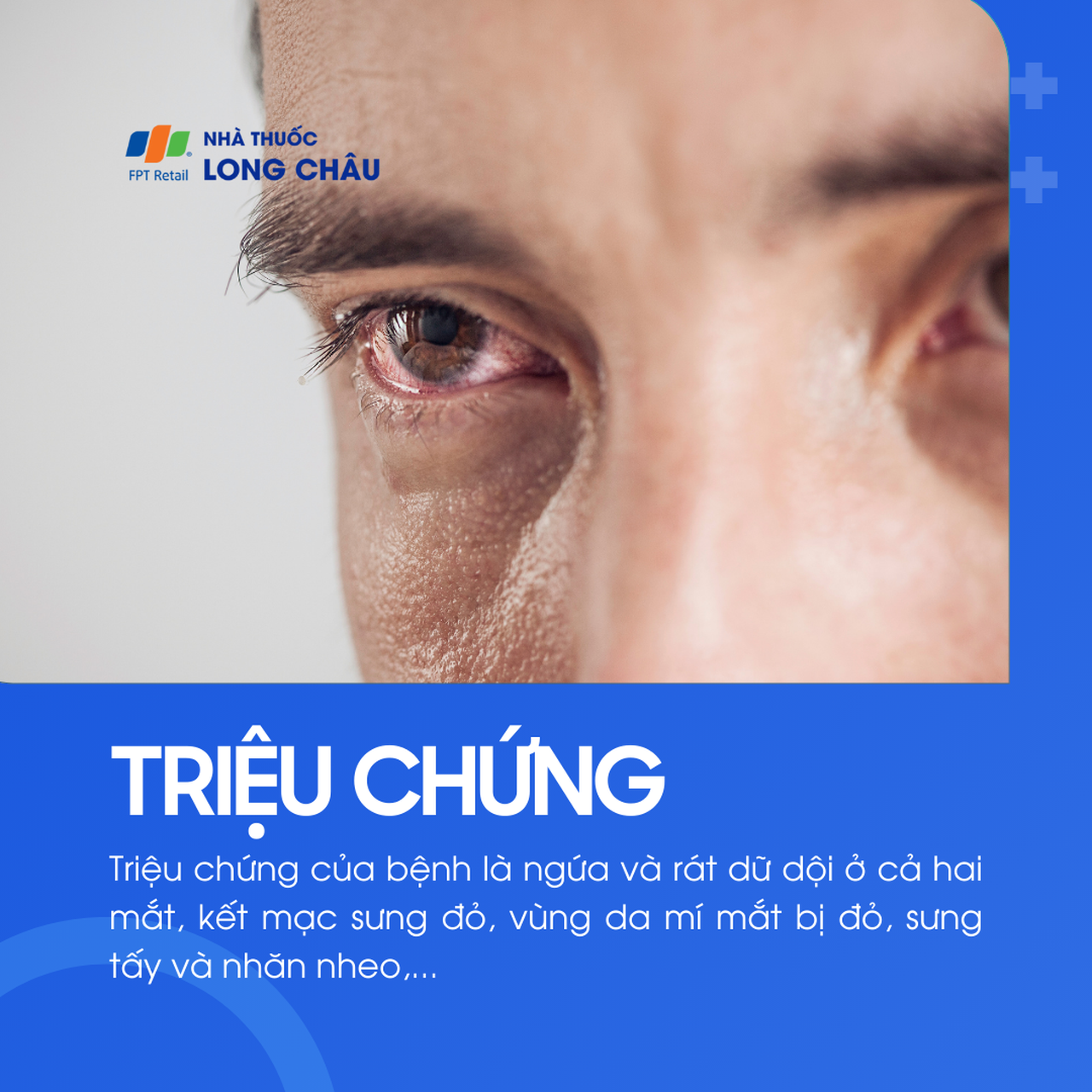 Viêm kết mạc dị ứng 2