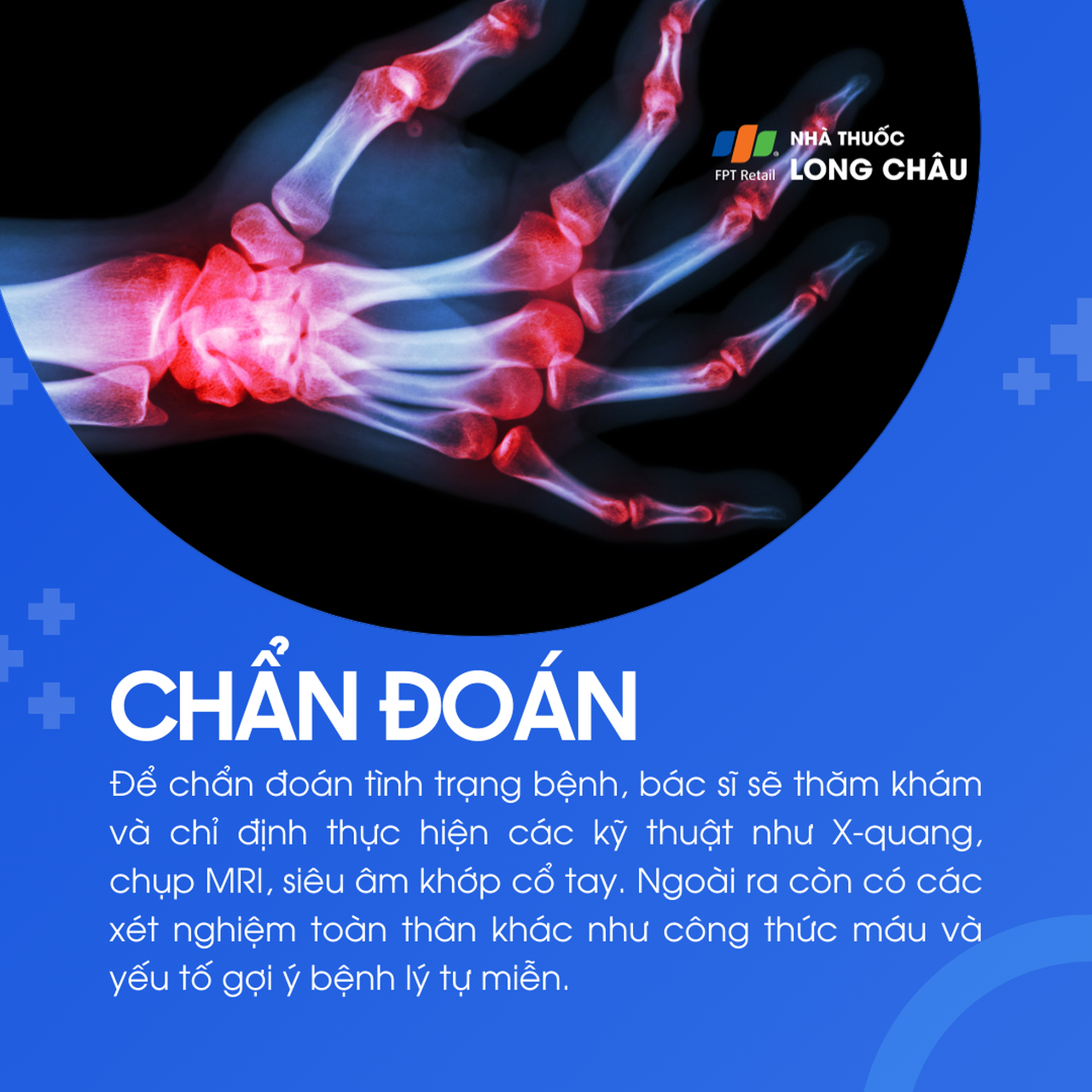 Viêm khớp cổ tay 5