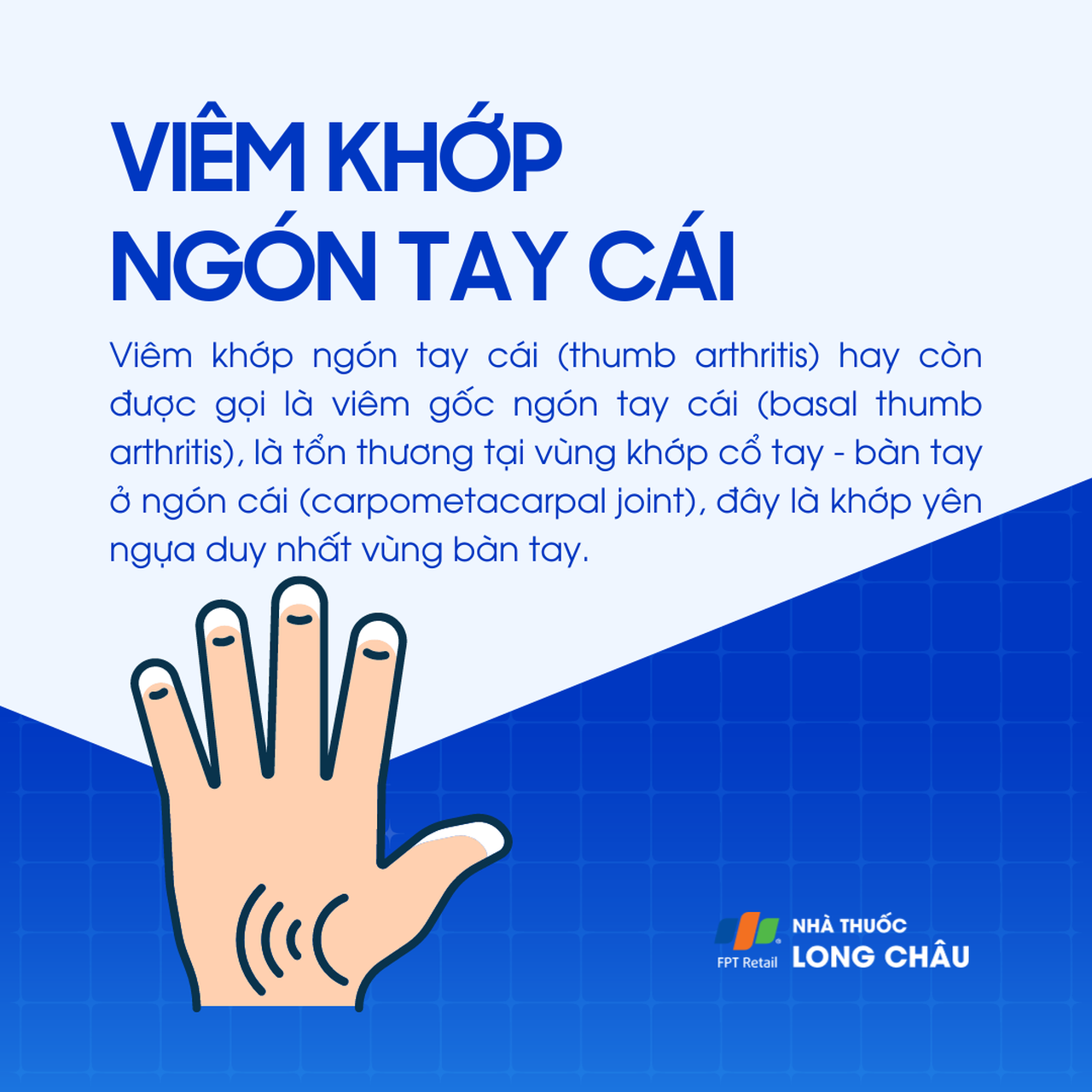 Viêm khớp ngón tay cái 1