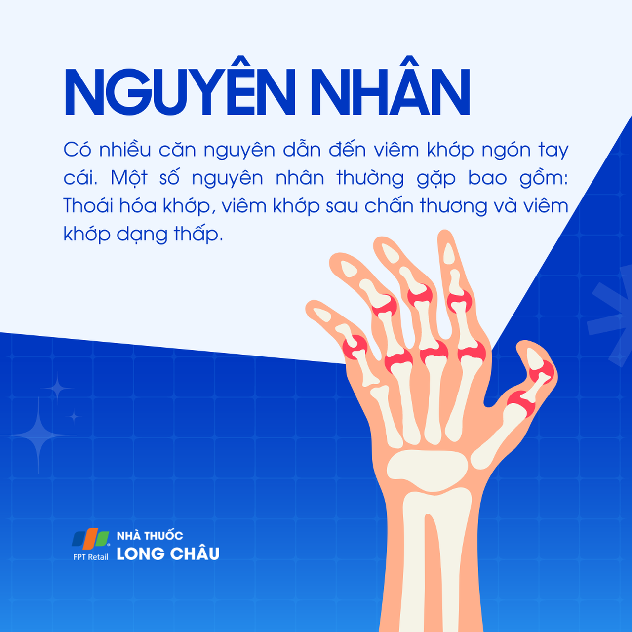 Viêm khớp ngón tay cái 3