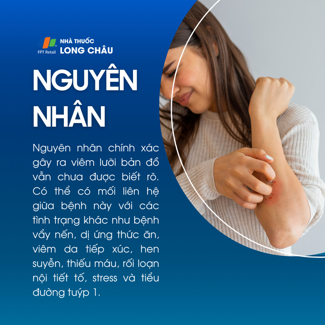 Viêm lưỡi bản đồ 3
