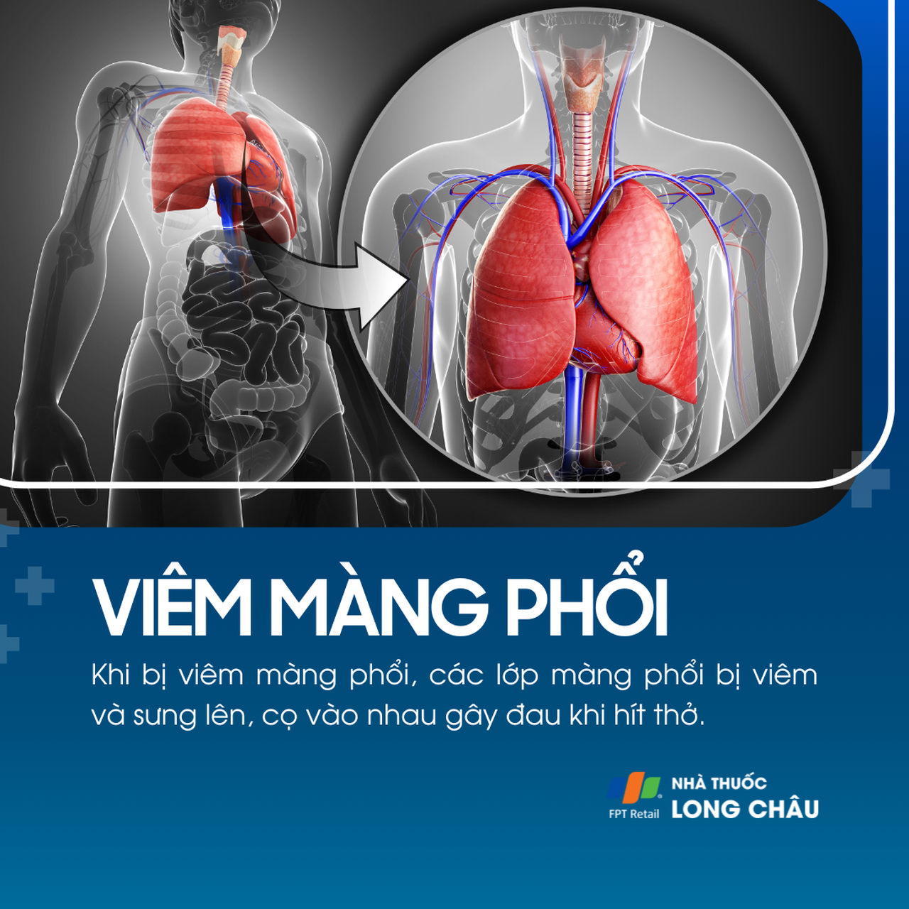 Viêm màng phổi 1