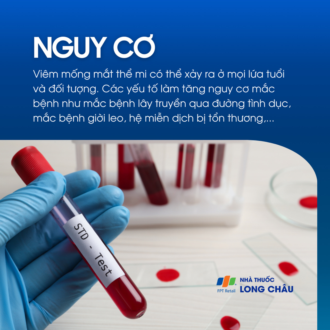 Viêm mống mắt thể mi 4