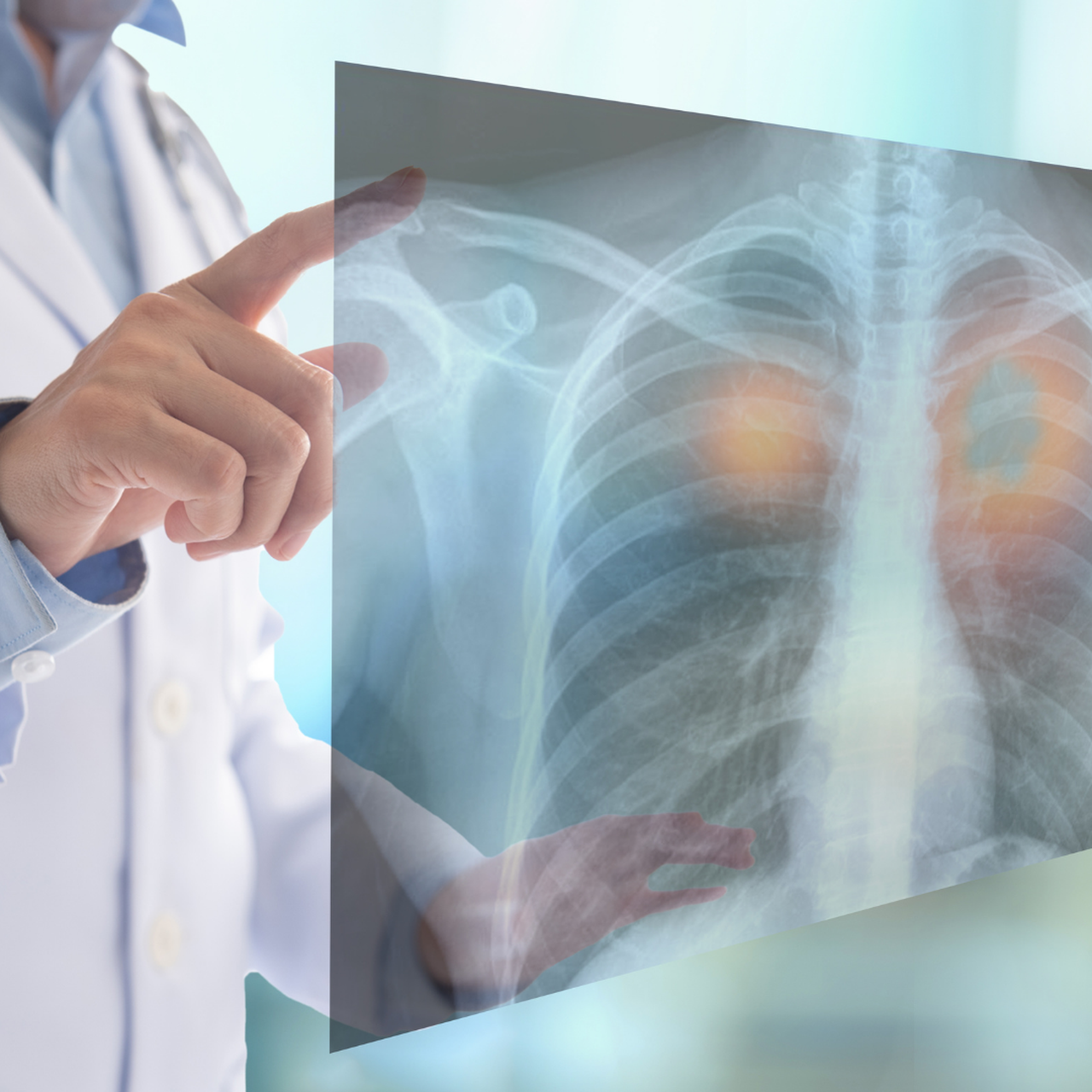 Viêm phế quản phổi 1