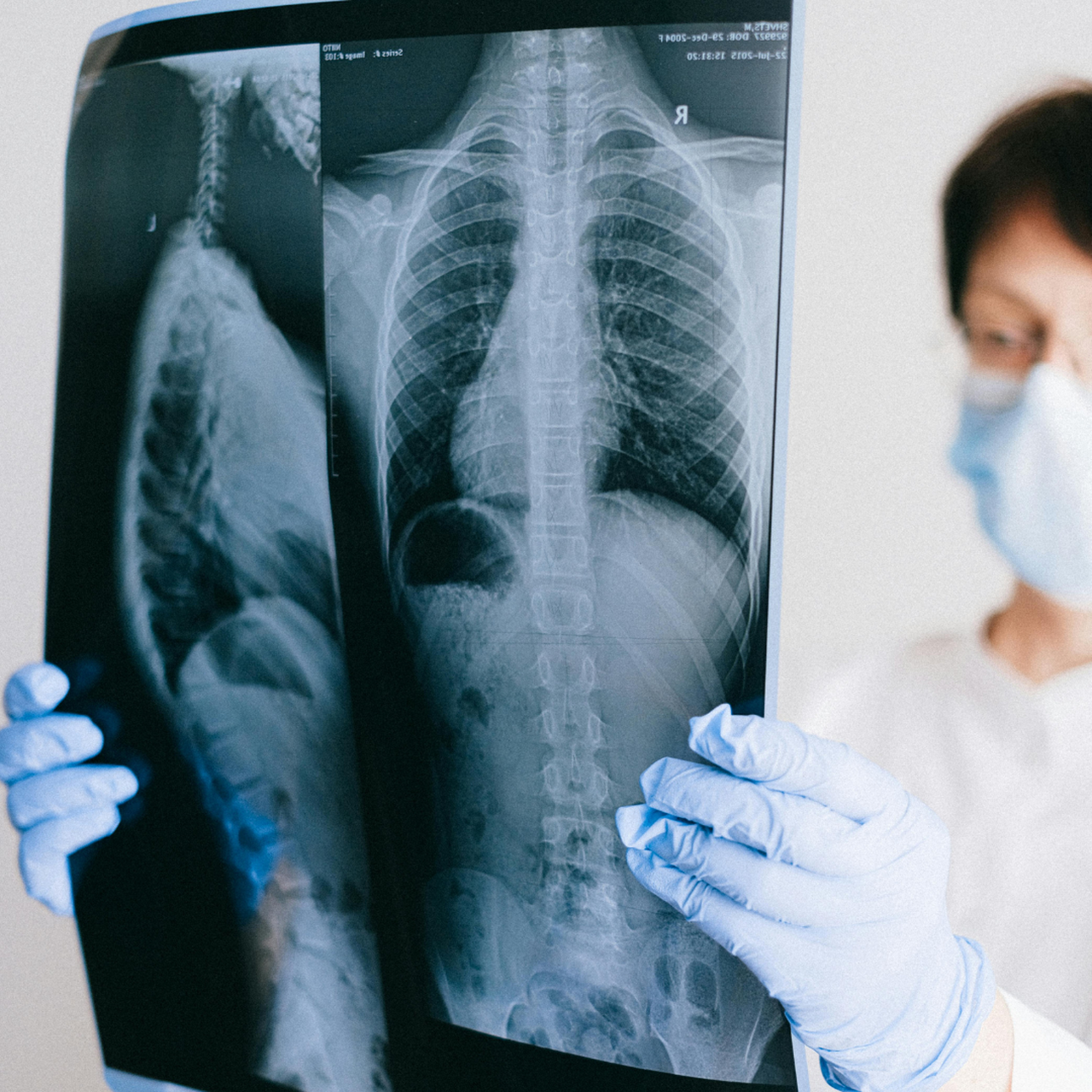 Viêm phổi cộng đồng 2