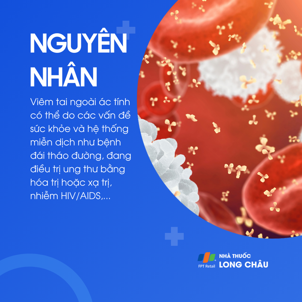 Viêm tai ngoài ác tính 3