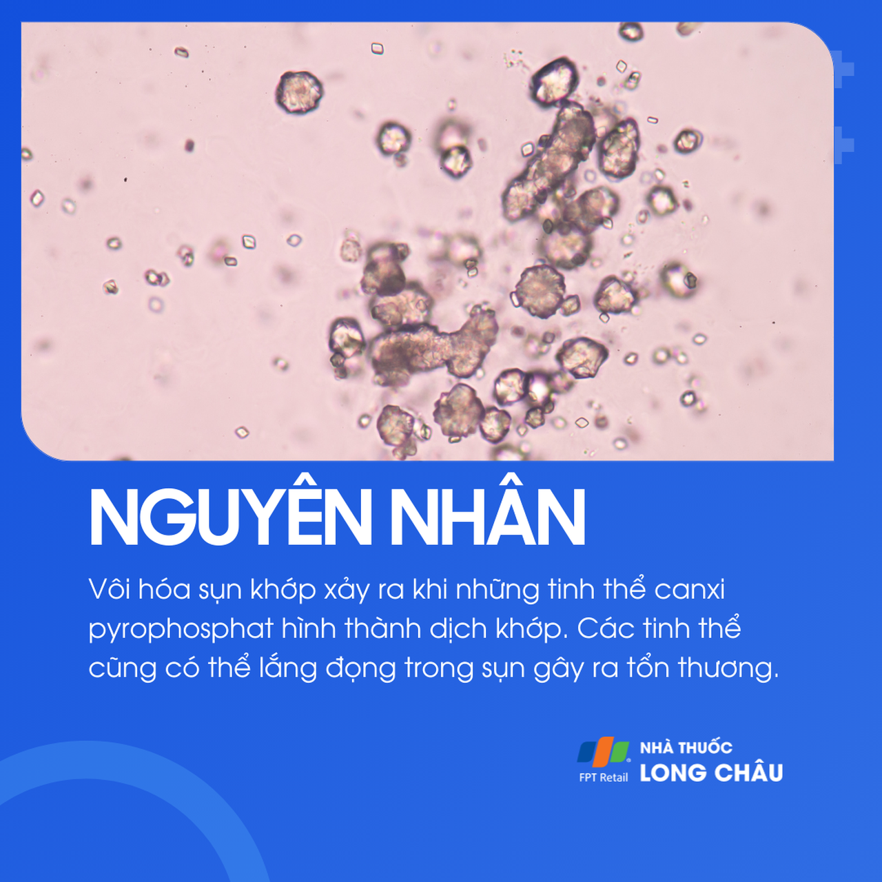 Vôi hóa sụn khớp 3