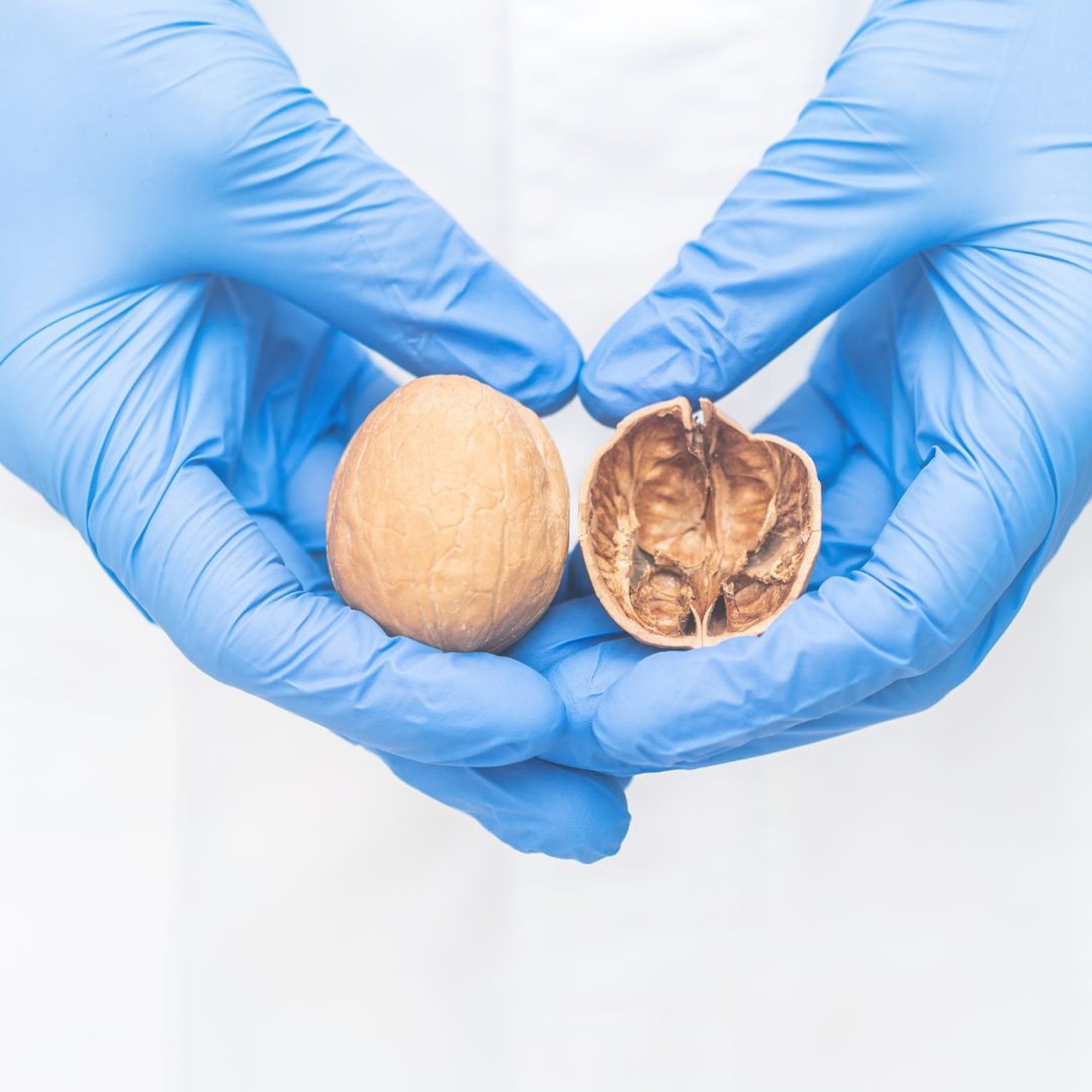 Vôi hóa tinh hoàn 1