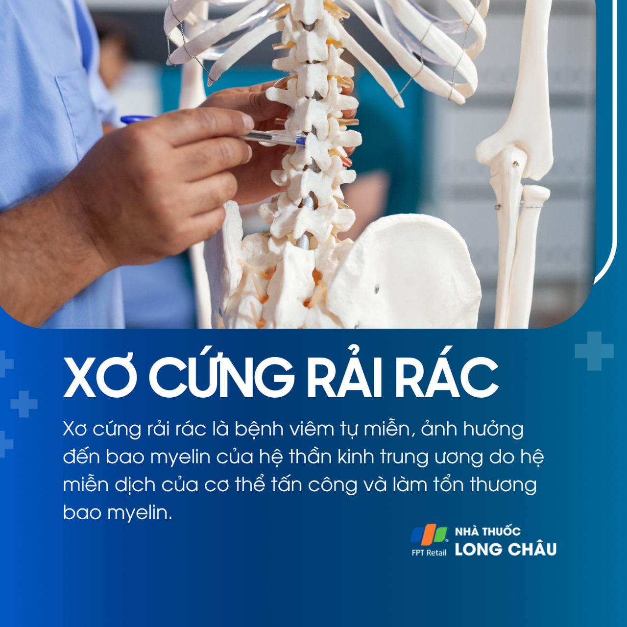 Xơ cứng rải rác 1
