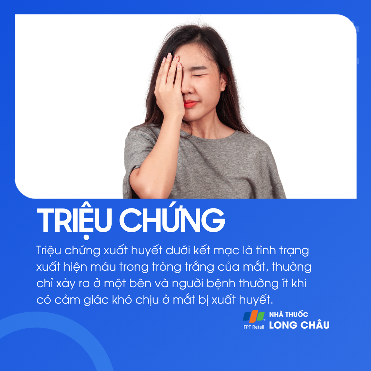 Xuất huyết dưới kết mạc 2