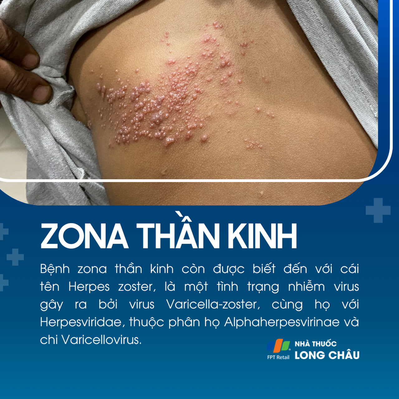 Bệnh zona thần kinh do virus Varicella-zoster