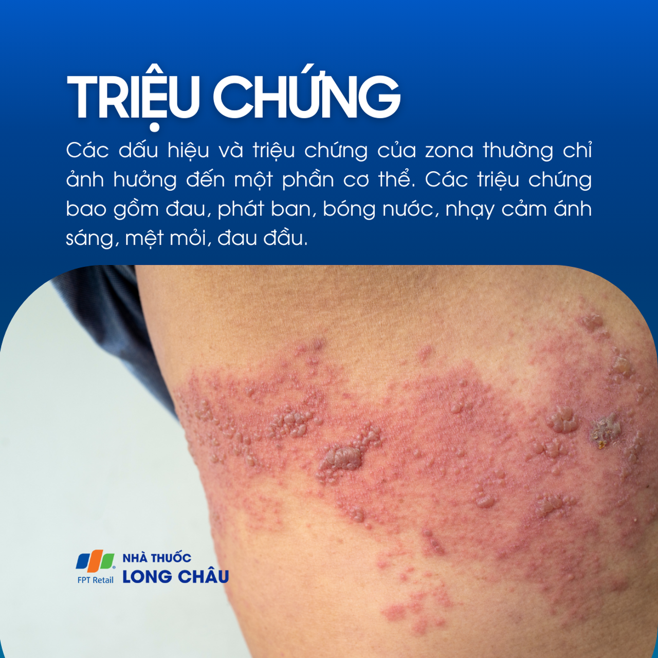 Triệu chứng bệnh zona thần kinh với phát ban và mụn nước