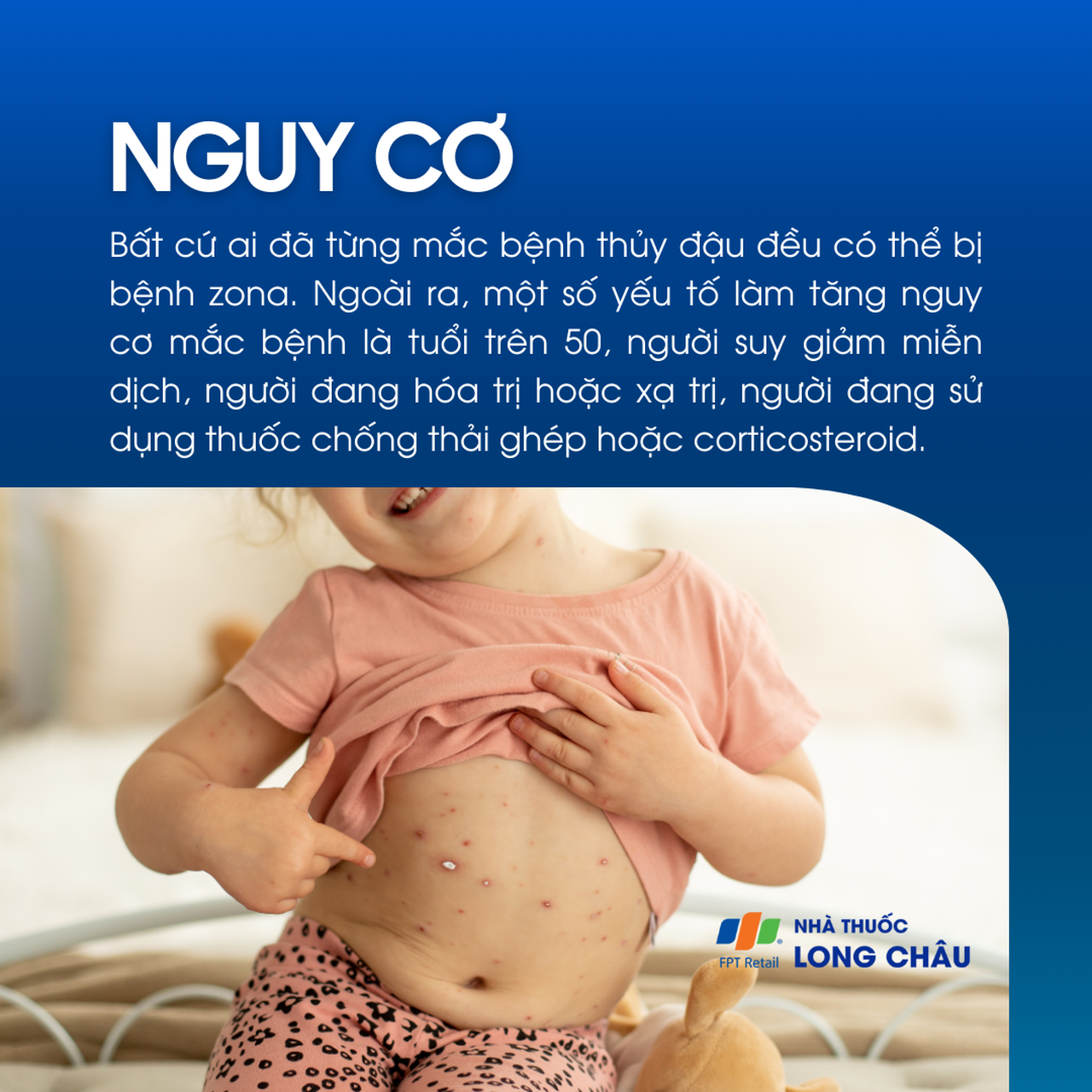 Nguy cơ mắc bệnh zona thần kinh ở người từng bị thủy đậu