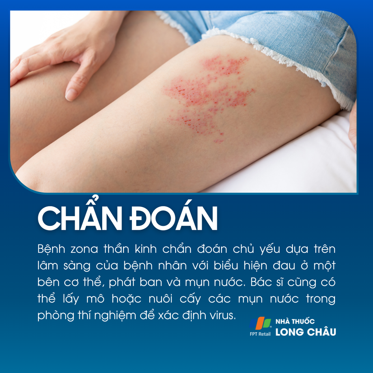 Chẩn đoán bệnh zona thần kinh qua biểu hiện phát ban