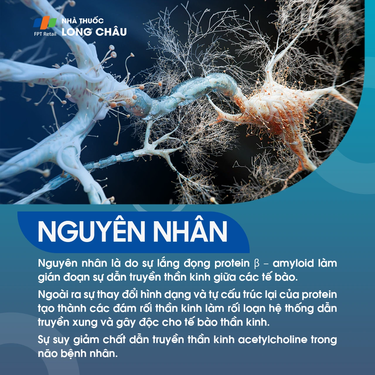 Nguyên nhân gây bệnh Alzheimer, bao gồm yếu tố di truyền và tích tụ protein beta-amyloid