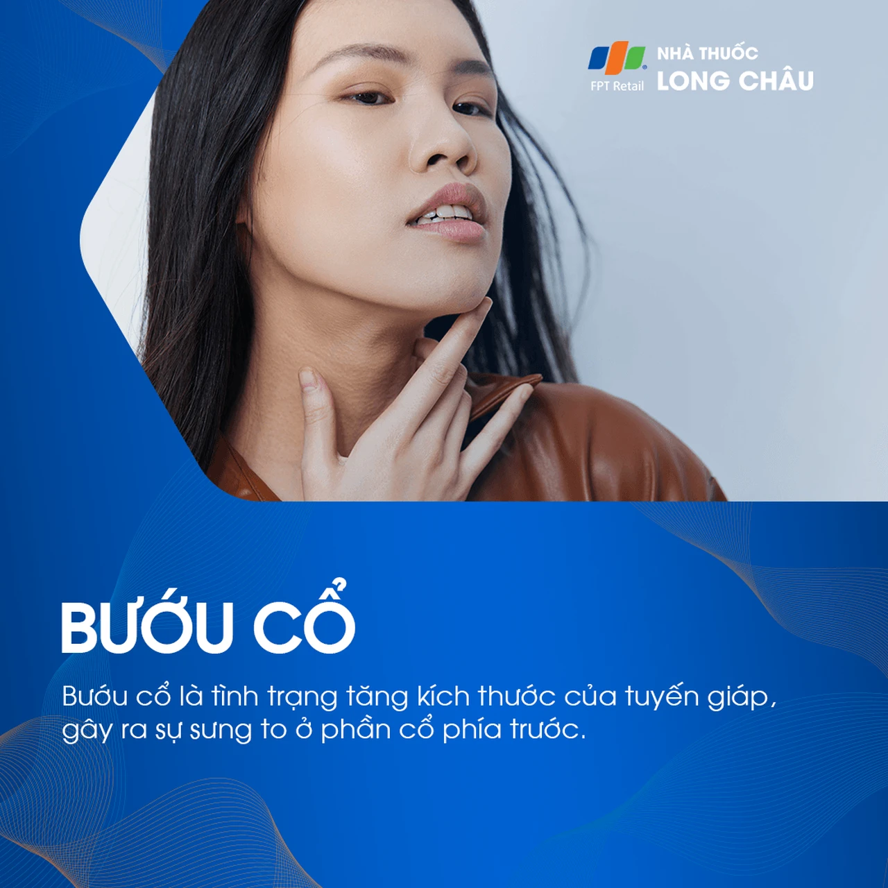 Bướu cổ là sự phì đại tuyến giáp gây sưng ở phần cổ trước