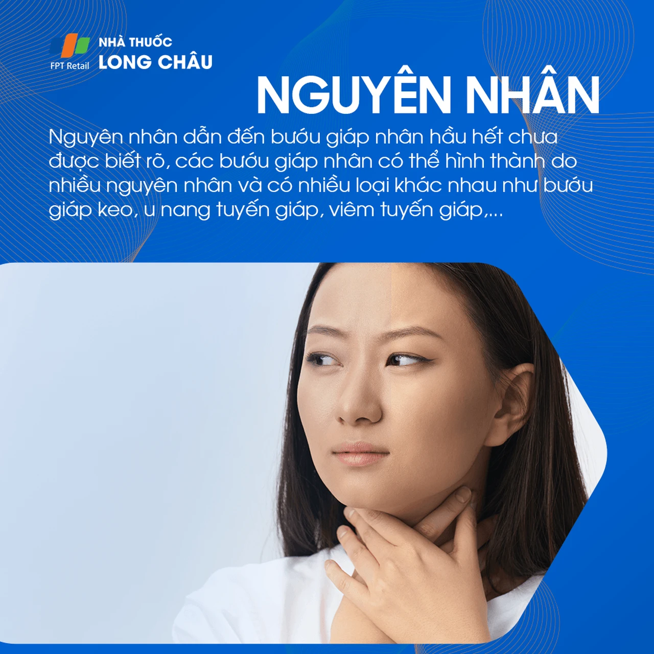 Bướu giáp nhân 3