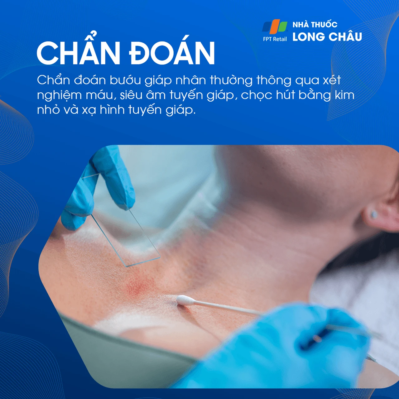 Bướu giáp nhân 5