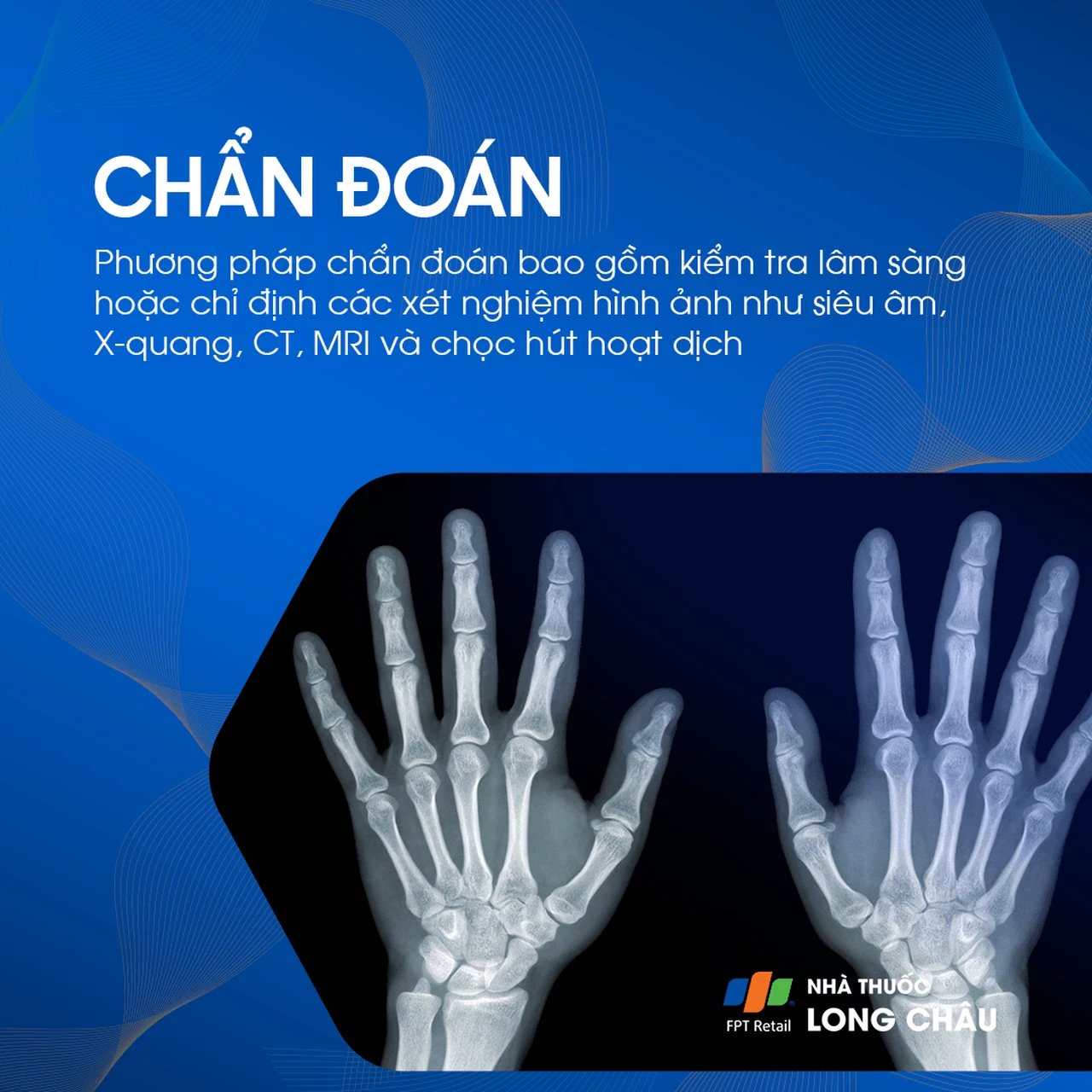 Bướu Hoạt Dịch Cổ Tay 5