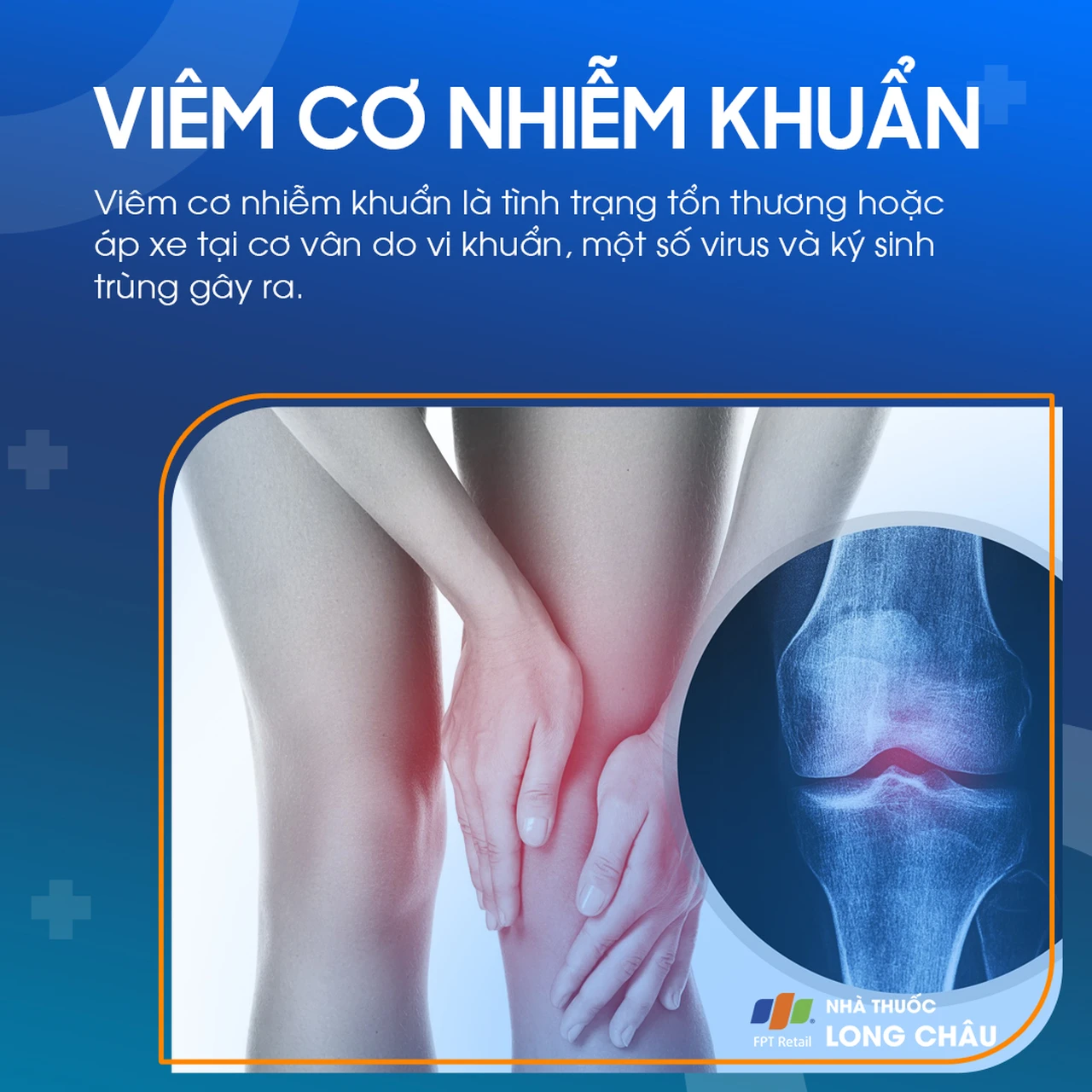 Viêm Cơ Nhiễm Khuẩn 1