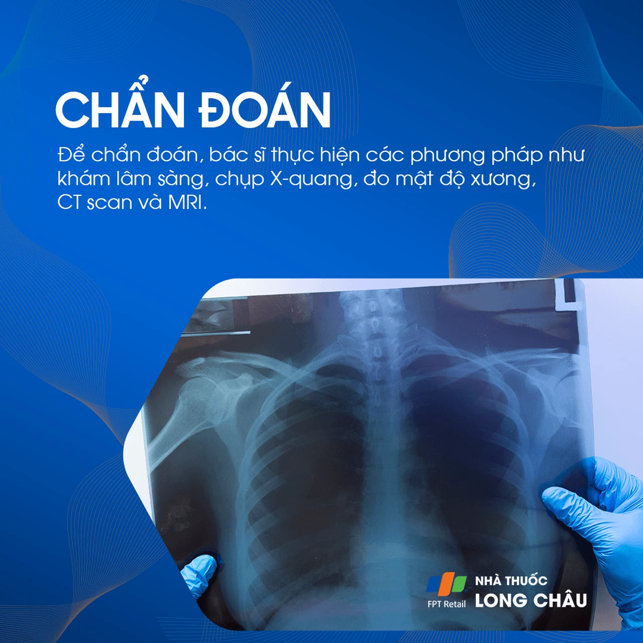 Xẹp Đốt Sống 5