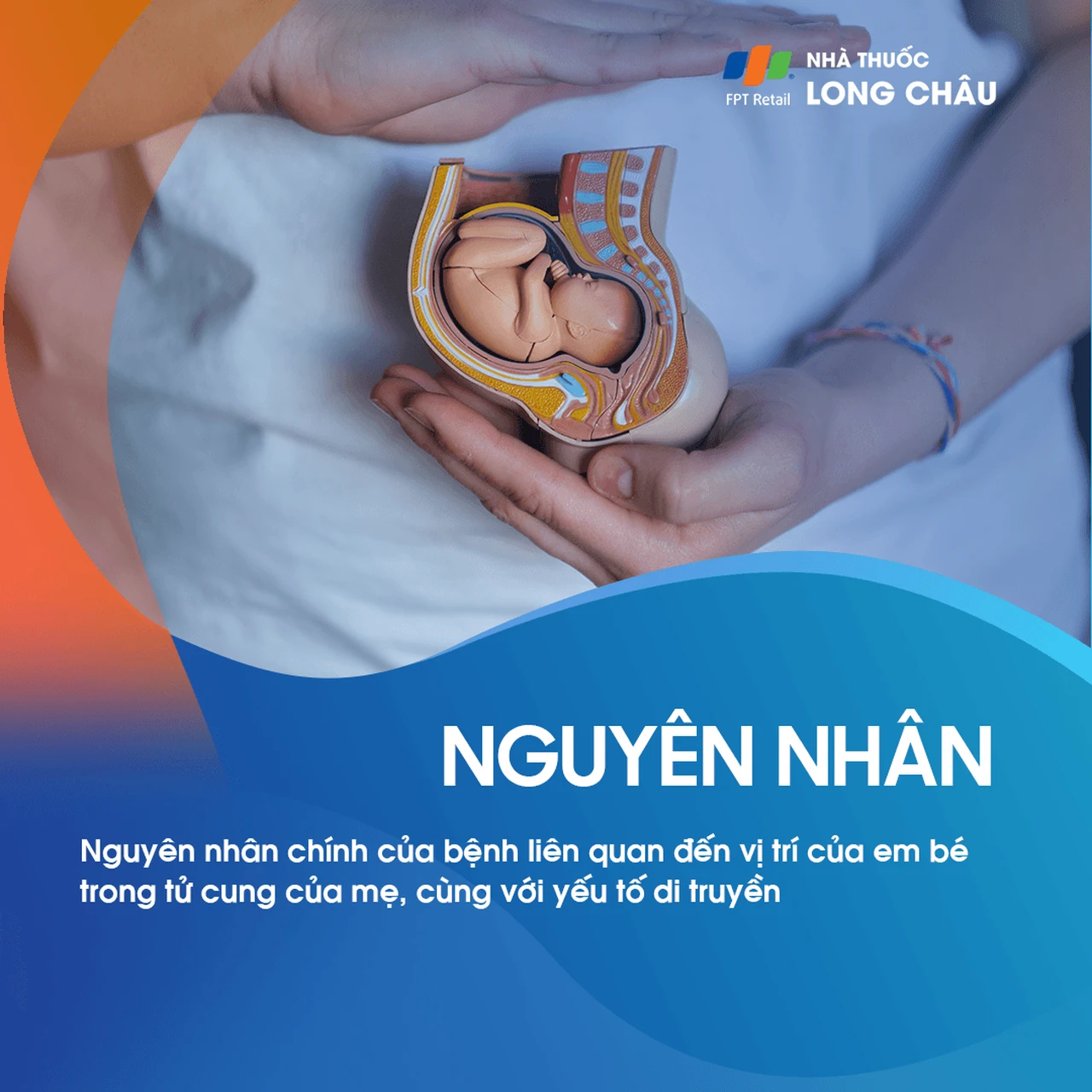 Xoắn Xương Đùi 3