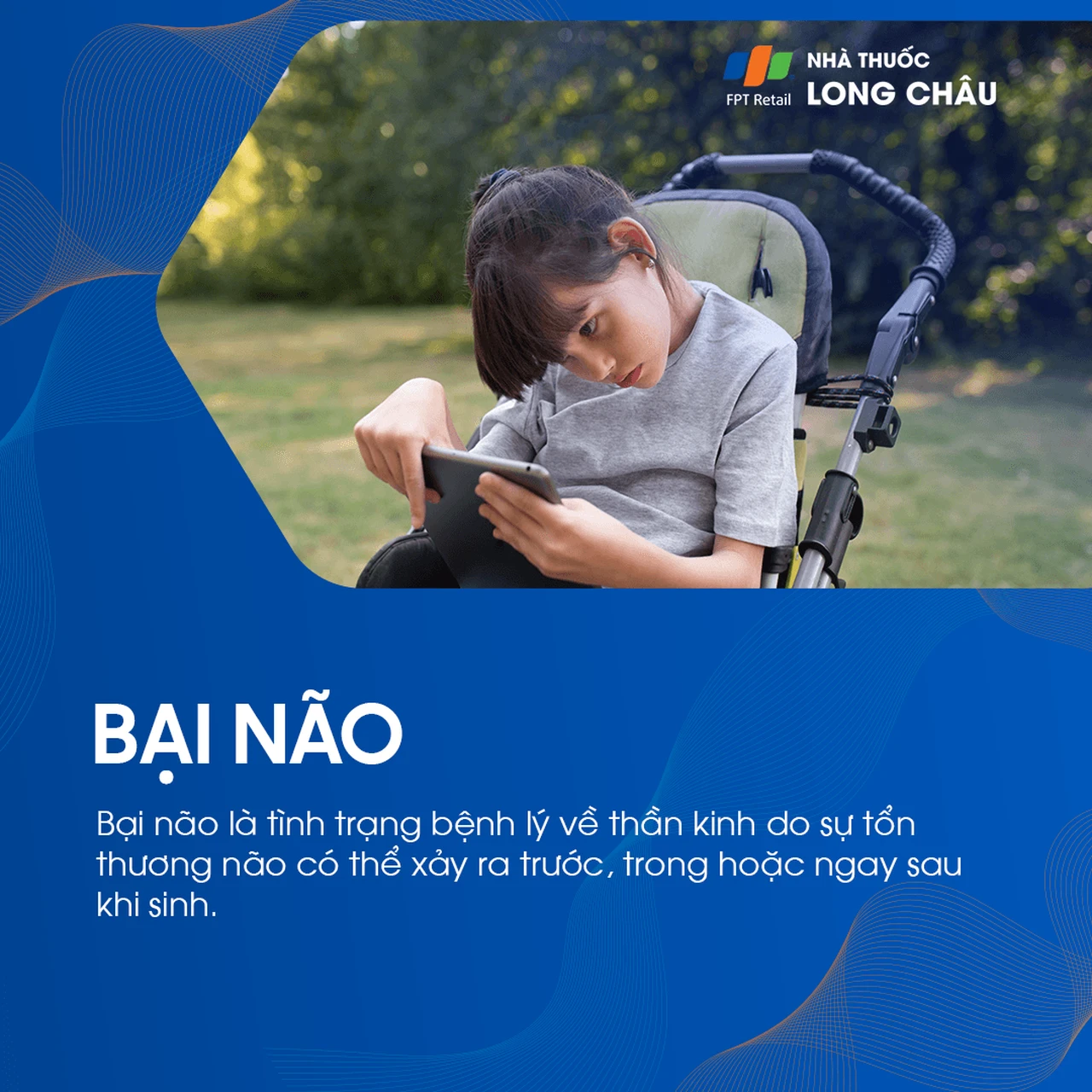 Bại não là tình trạng tổn thương não ảnh hưởng đến hệ thần kinh xảy ra trước, trong hoặc sau sinh