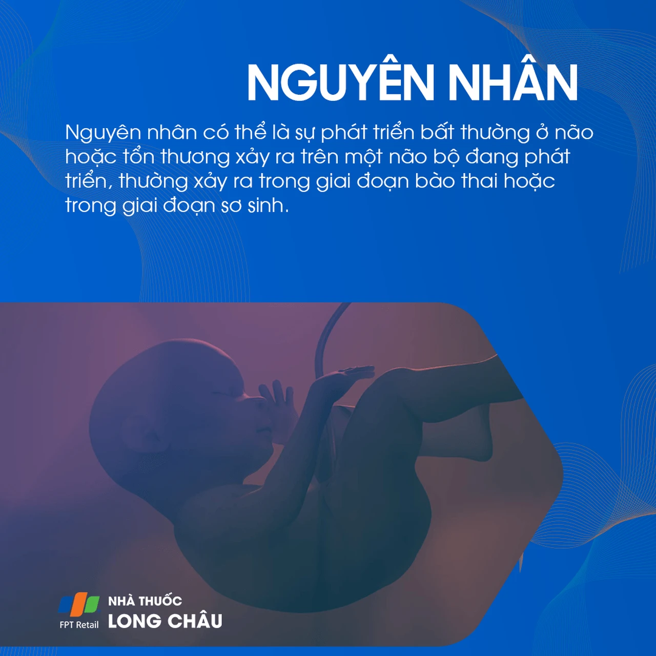 Nguyên nhân bại não là do bất thường phát triển hoặc tổn thương não trong thai kỳ hoặc sơ sinh