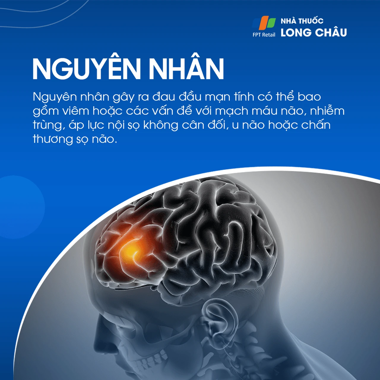 Đau đầu mạn tính 3