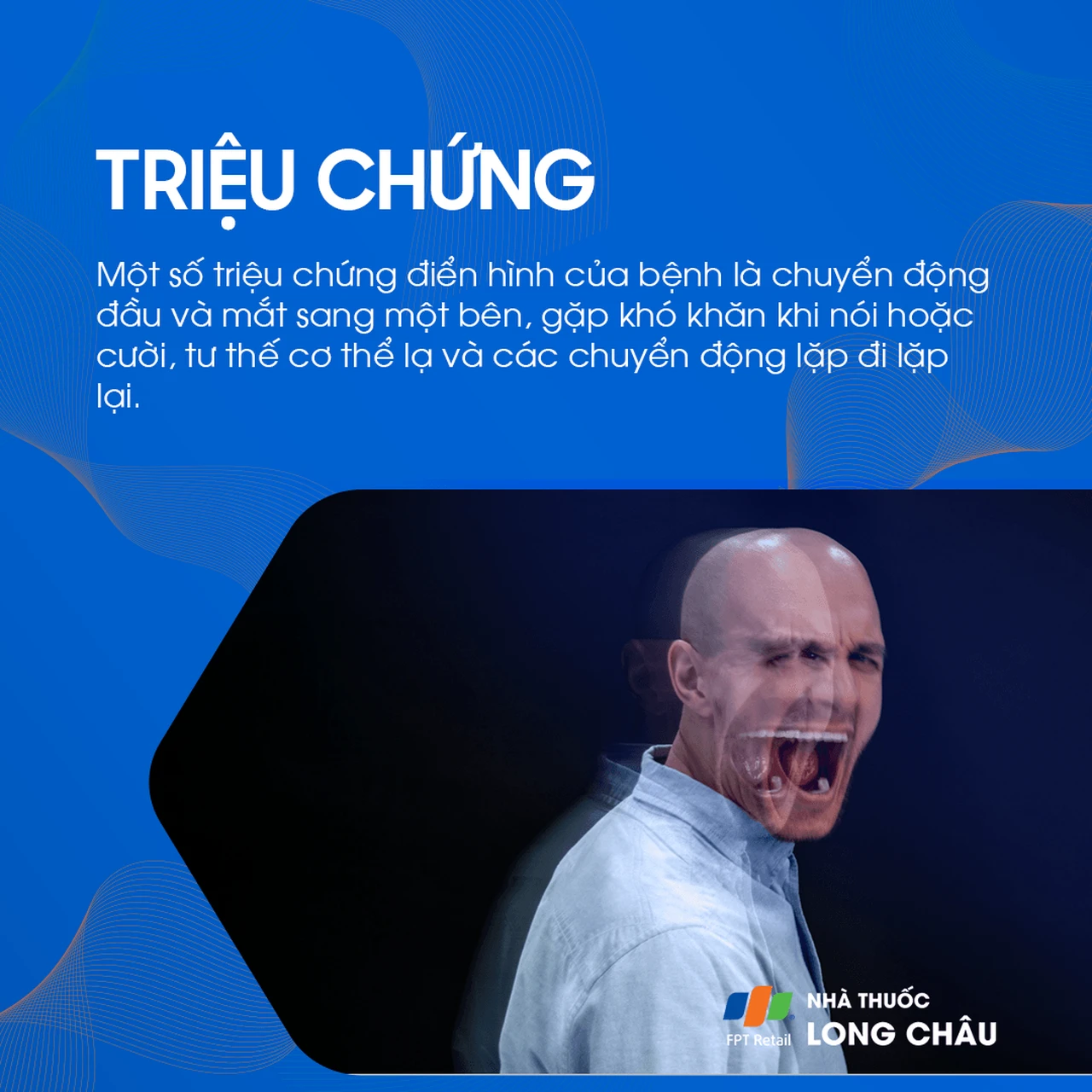 Động kinh thùy trán 2