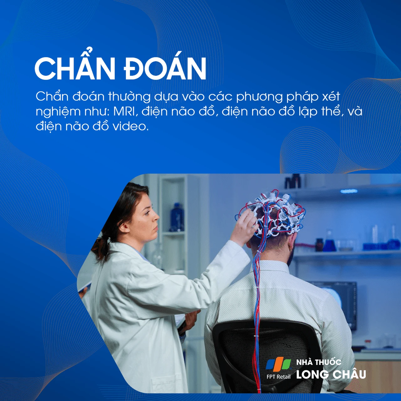 Động kinh thùy trán 5